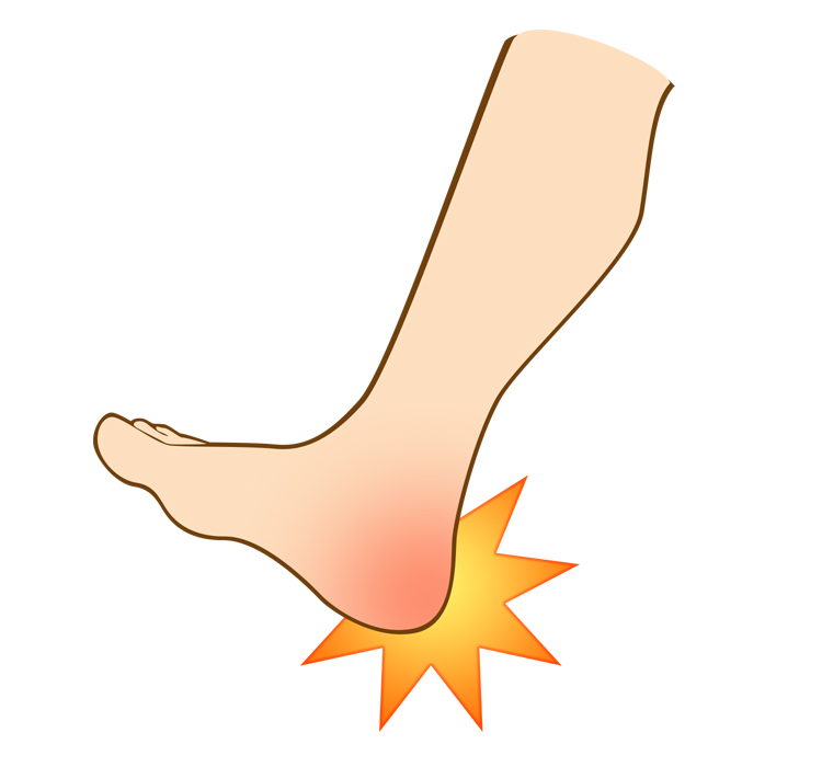 成長期の子どもに多い、かかと周辺の痛みを示すイラスト