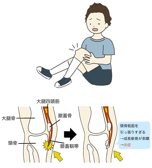 オスグッドで痛みが出やすい膝のお皿の下の位置を示したイラスト